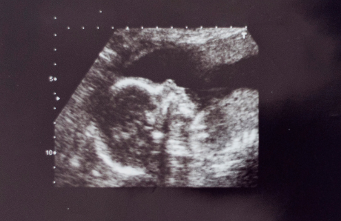 Imagen de una ecografía de un bebé